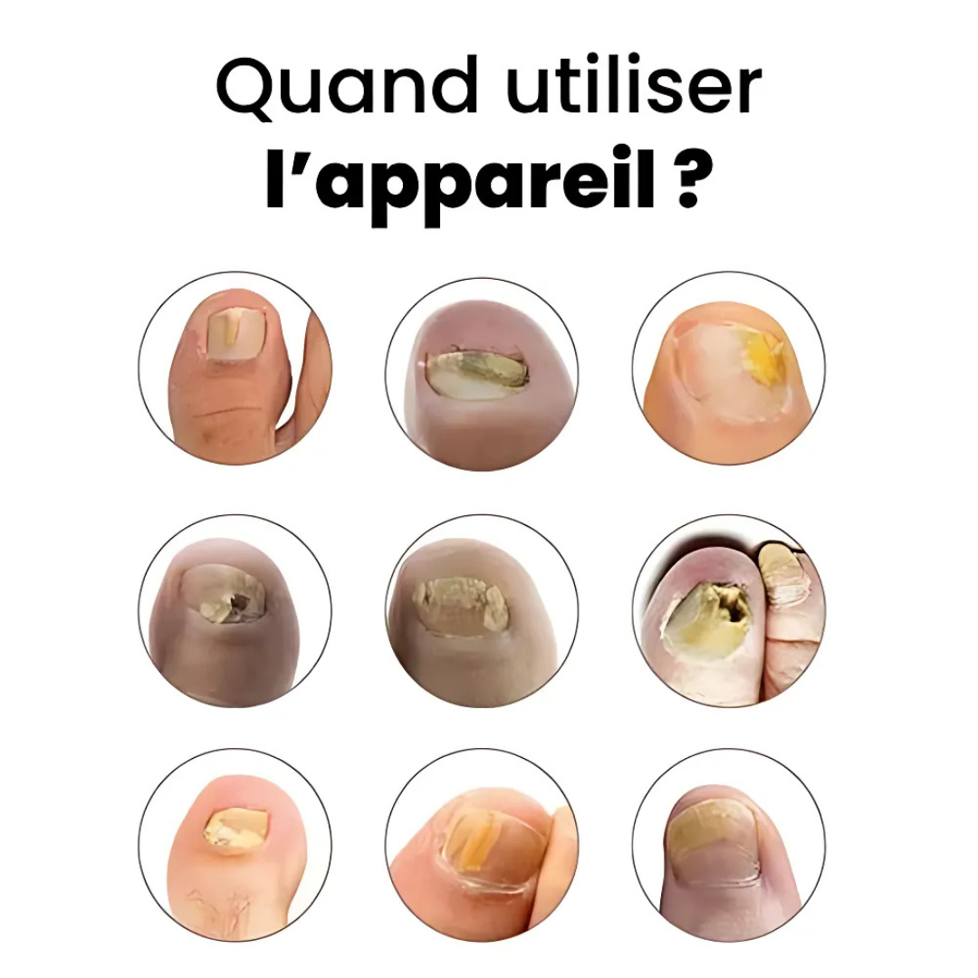 Appareil contre les mycoses des ongles
