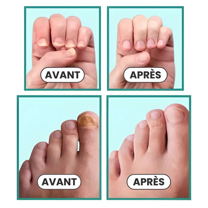 Appareil contre les mycoses des ongles