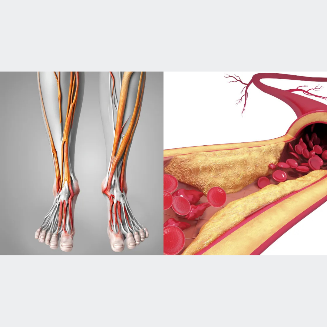 Appareil à vibrations contre la neuropathie