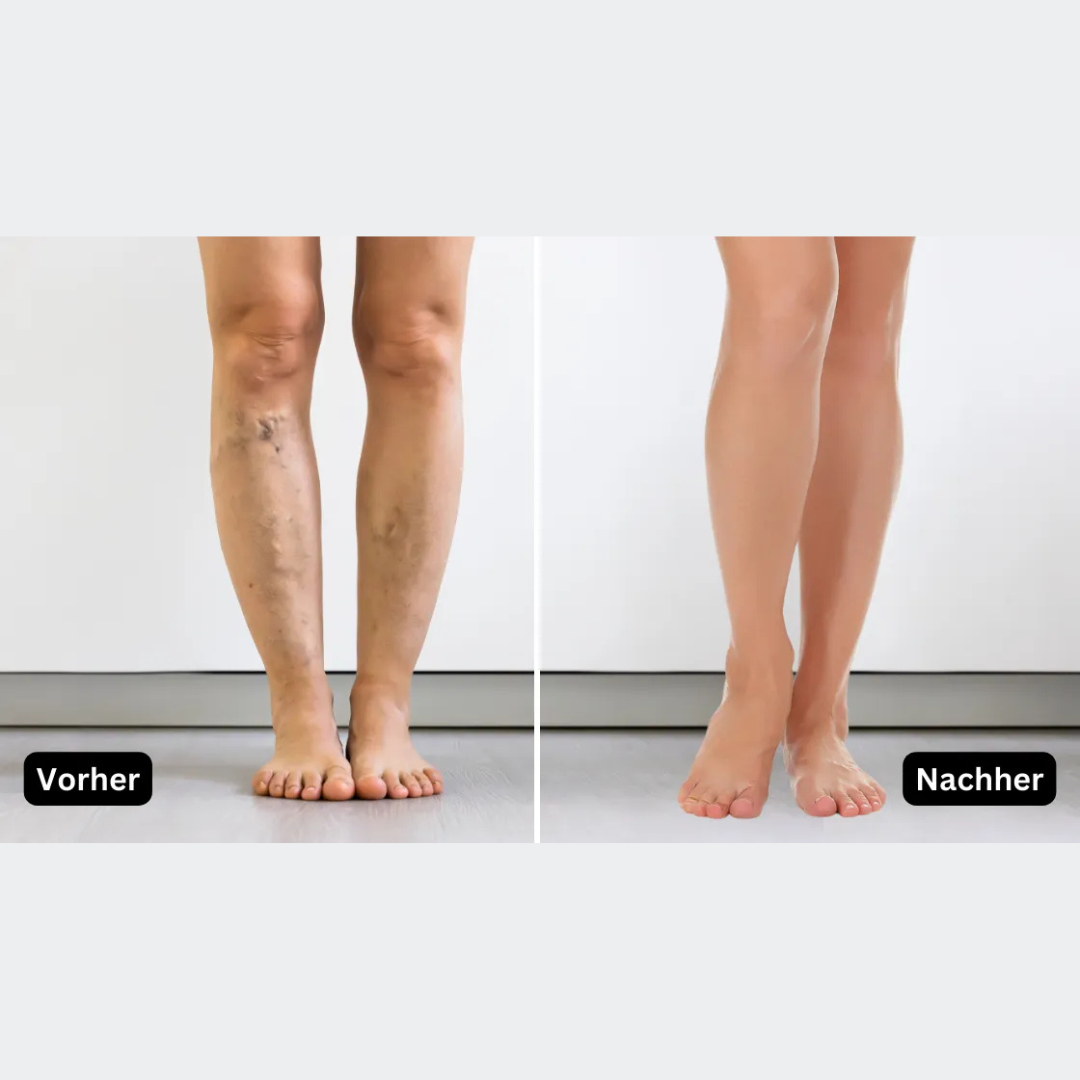 Appareil à vibrations contre la neuropathie