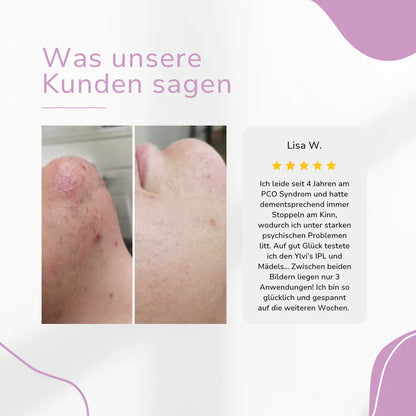 Ylvis IPL Épilateur