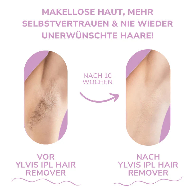 Ylvis IPL Épilateur